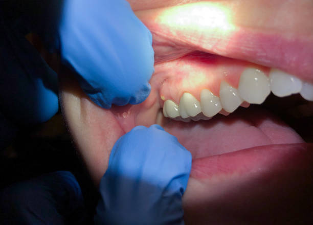 Best Emergency Dentist for Lost Fillings or Crowns in Ponce Inlet, FL